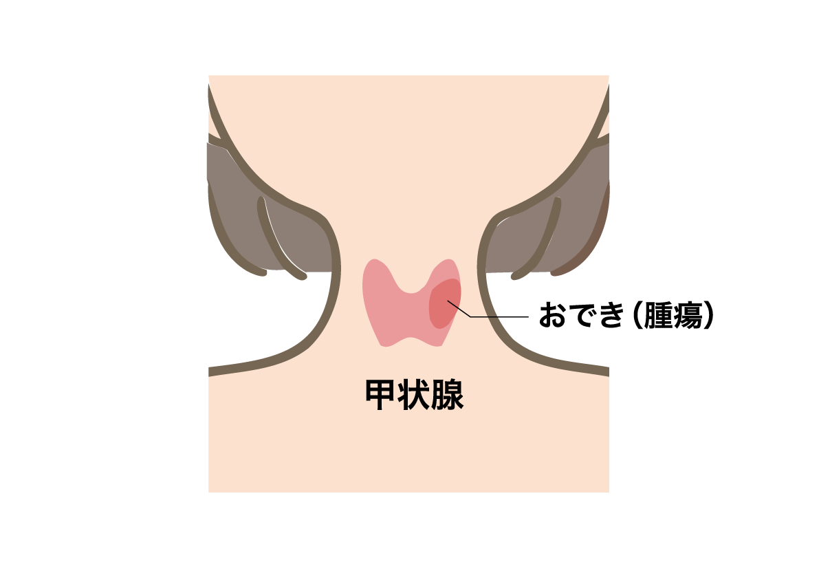 首元の甲状腺の腫瘍