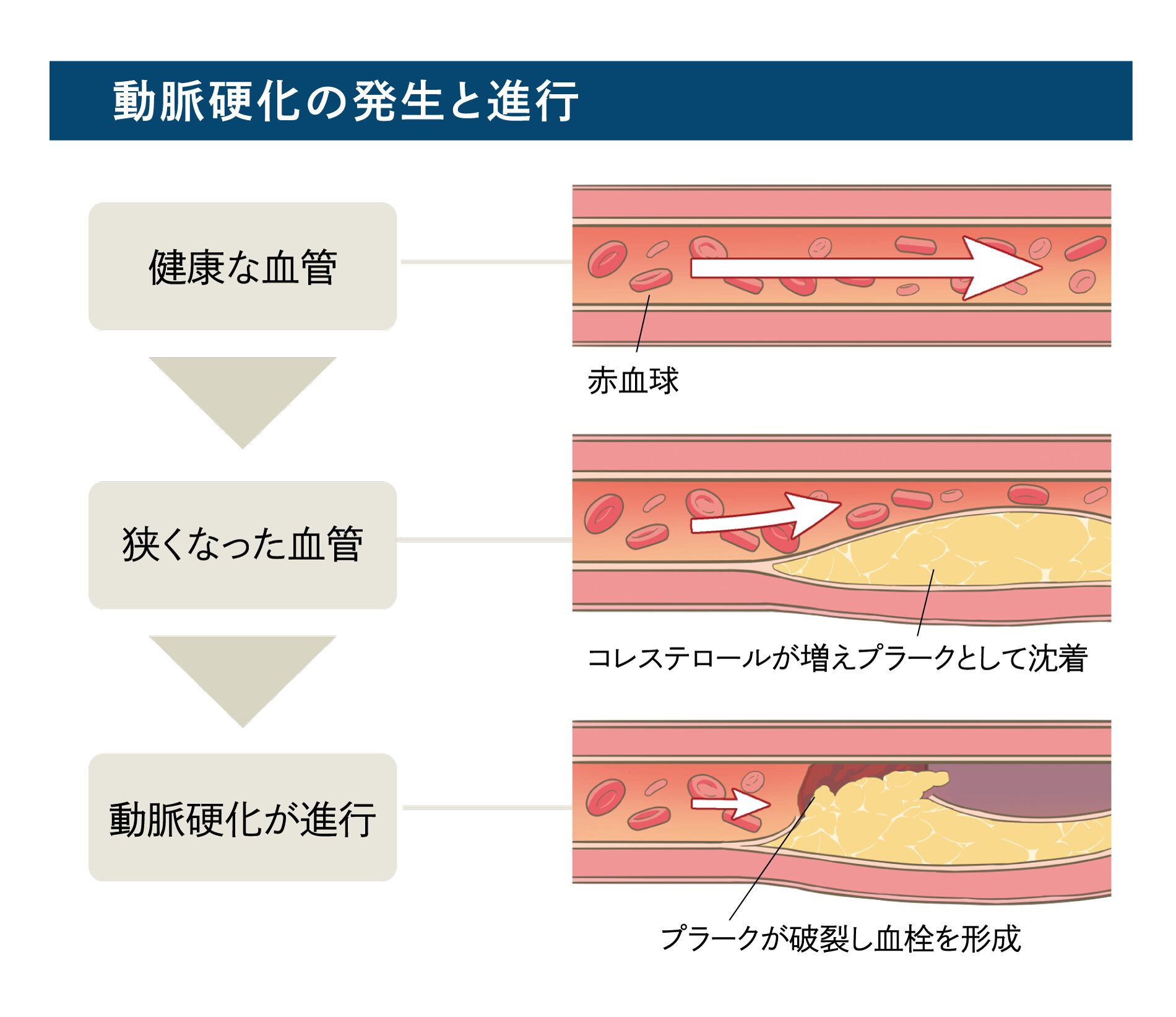 動脈硬化の発生と進行